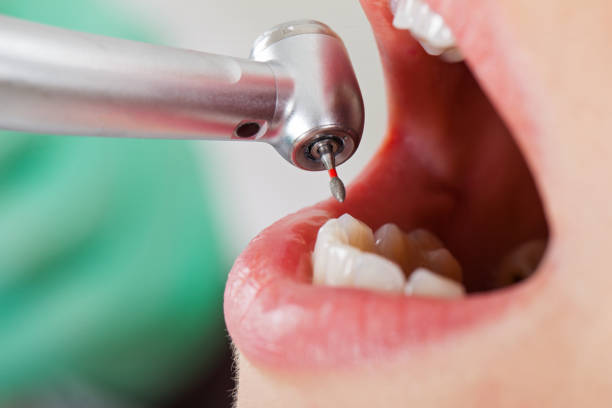 Best Broken or Cracked Tooth Emergency Dentist in Osceola, IN